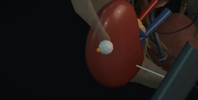 Operative plate: Renal allograft biopsy