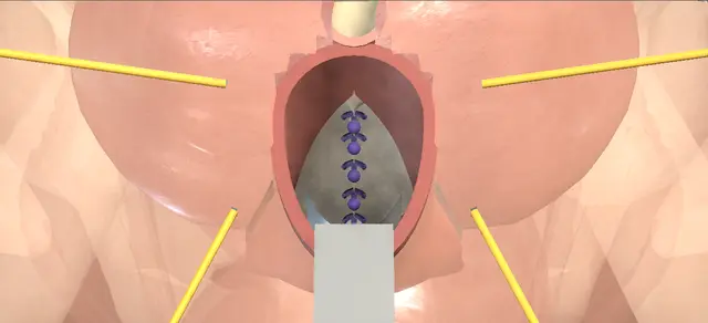 Operative plate: Anterior vaginal prolapse repair