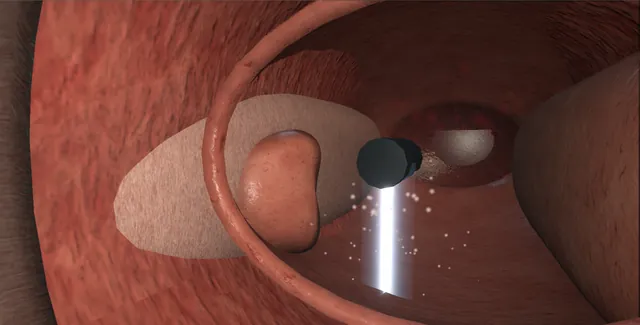 Operative plate: Aquablation: the planned waterjet