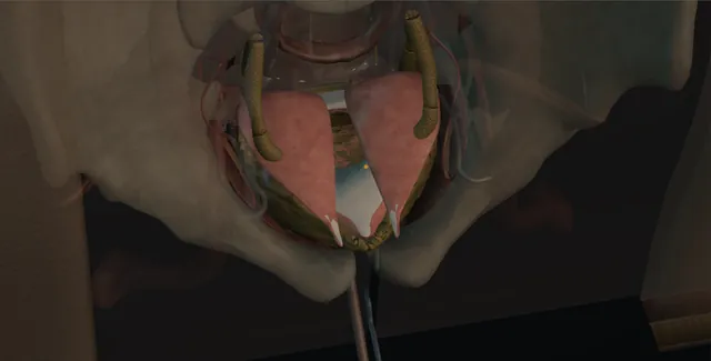 Operative plate: Augmentation cystoplasty