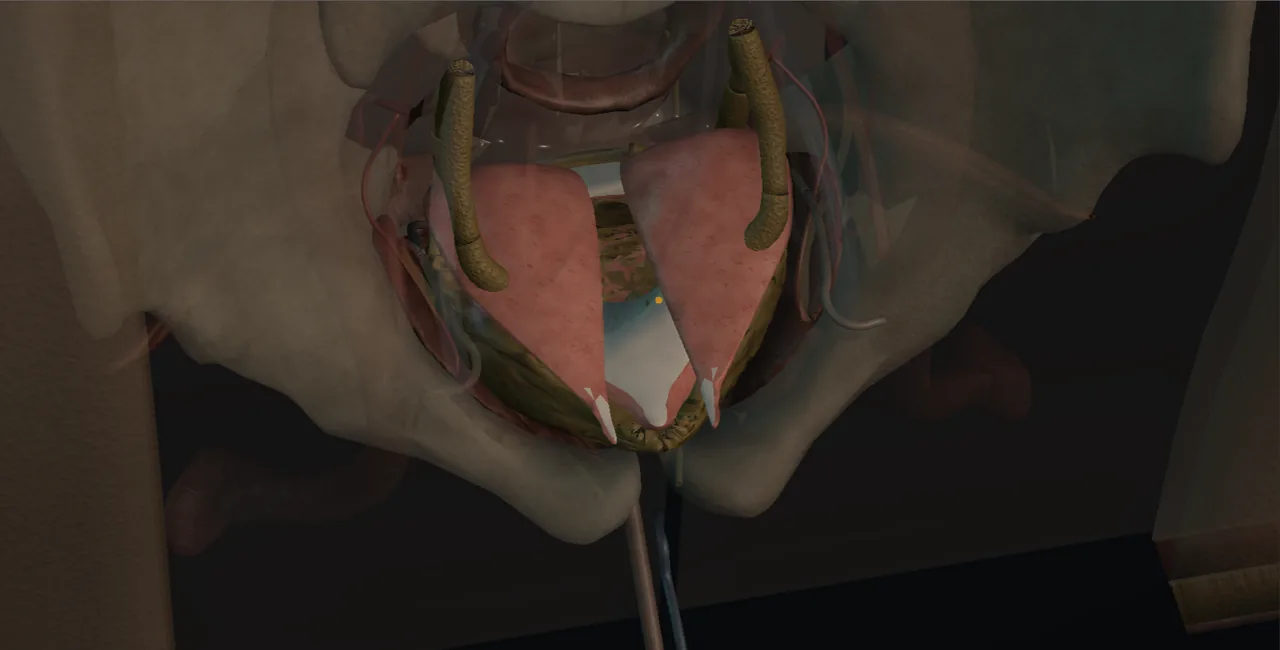 Rendered frame from the Interactive clam ileocystoplasty