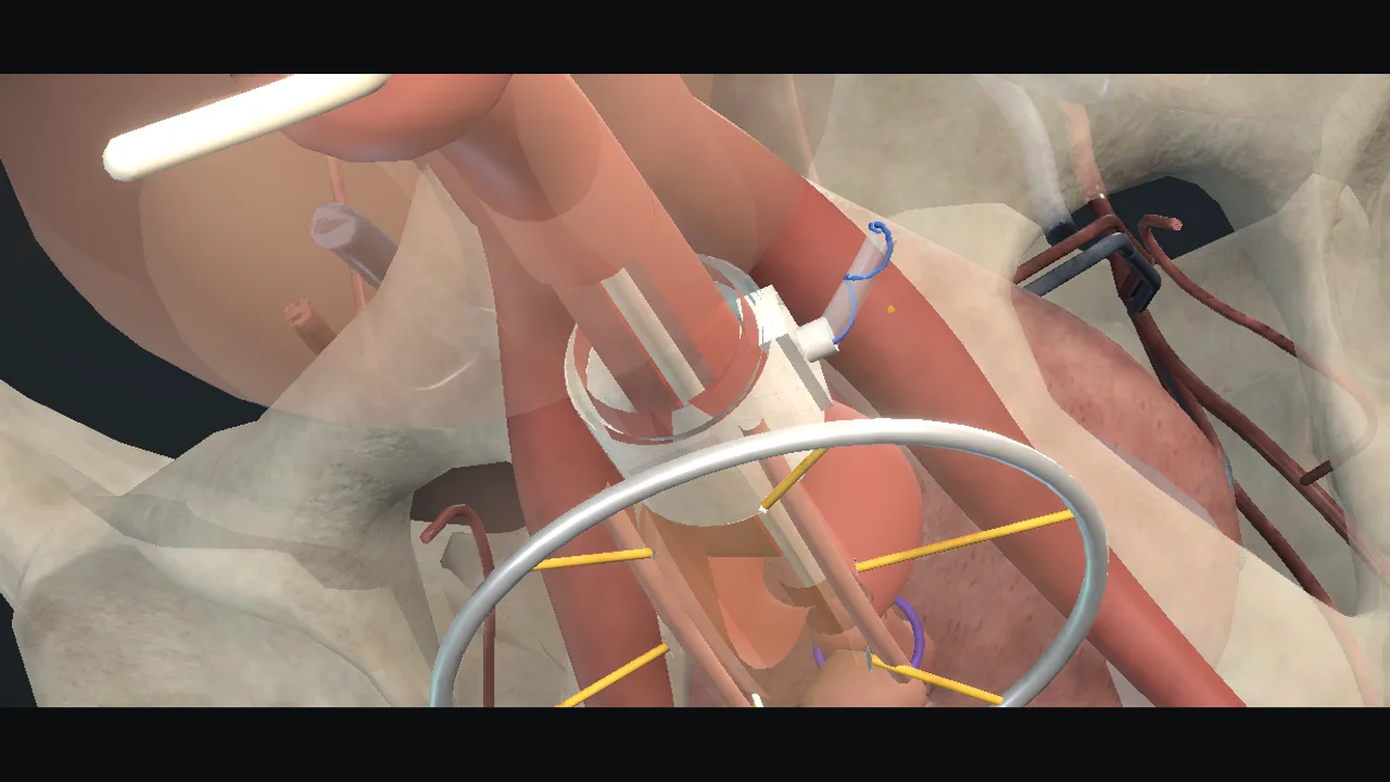 Artificial urinary sphincter: the cuff around the bulbar urethra