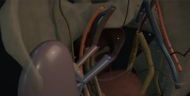 Operative plate: Renal autotransplantation