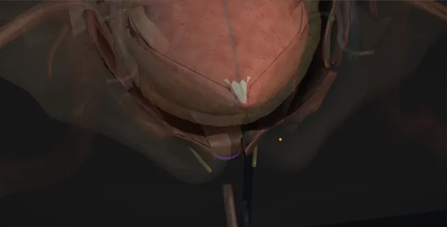 Operative plate: Bladder neck closure