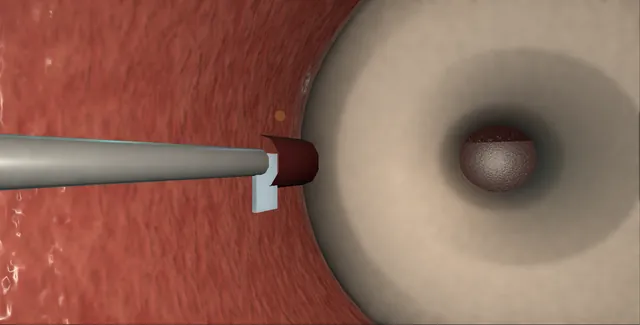 Operative plate: Bladder neck and anastomotic stenosis