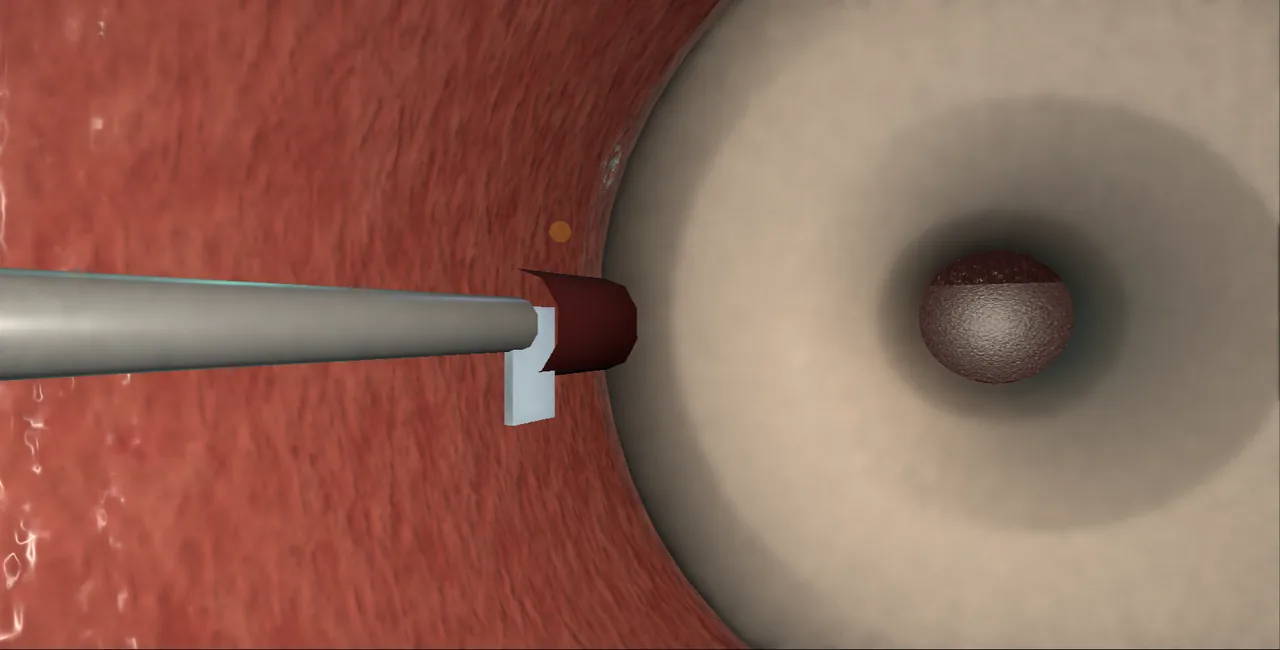 Bladder neck stenosis: the vesicourethral anastomosis with the rectum behind it