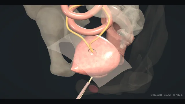 Operative plate: Bladder rupture