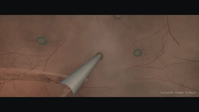 Operative plate: Intravesical botulinum toxin