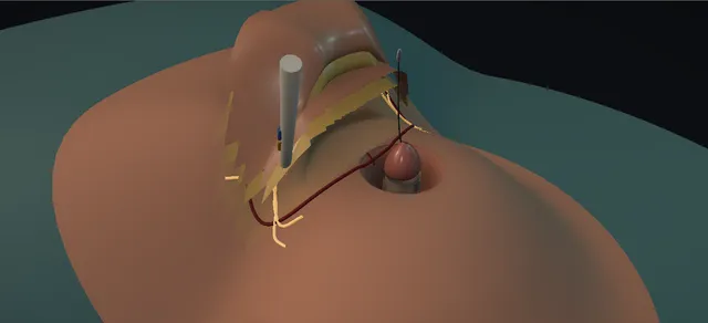 Operative plate: Adult acquired buried penis