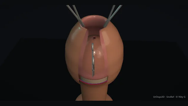 Operative teaching plate: Adult circumcision