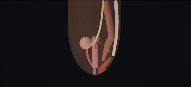 Operative plate: Cloacal reconstruction
