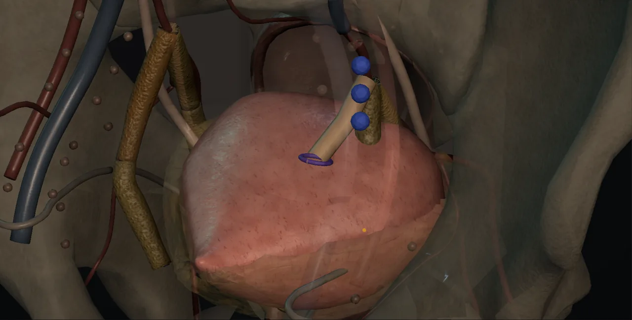 Distal ureteric reconstruction: psoas hitch and Boari flap