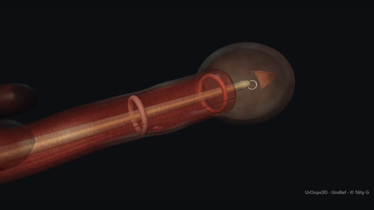 Optical urethrotomy: the incision through the stricture ring