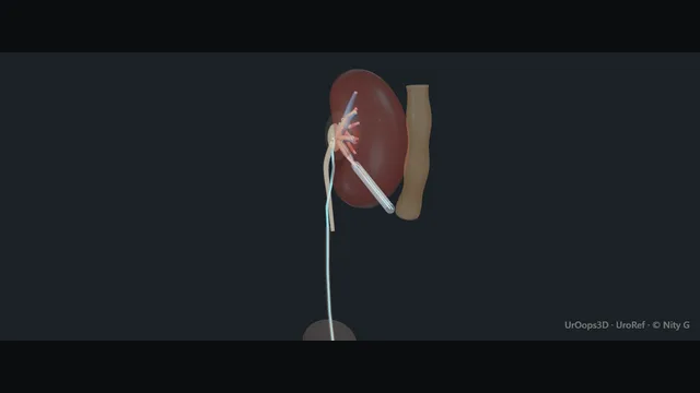 Operative plate: Combined intrarenal surgery