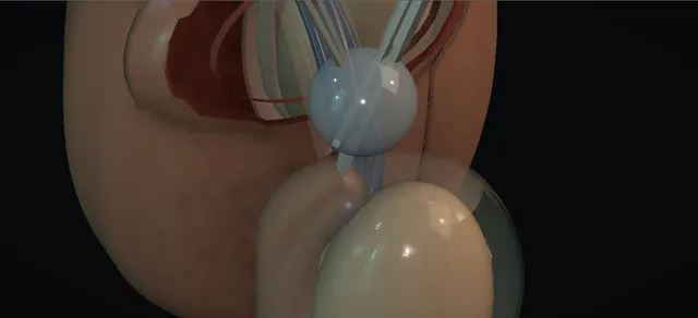Operative plate: Epididymal cyst excision