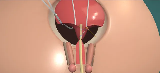 Operative plate: Bladder exstrophy repair