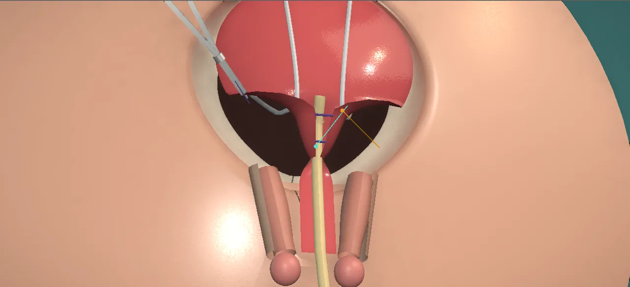 Rendered frame from the Interactive exstrophy closure