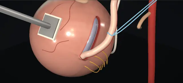 Operative plate: Extravesical ureteric reimplantation