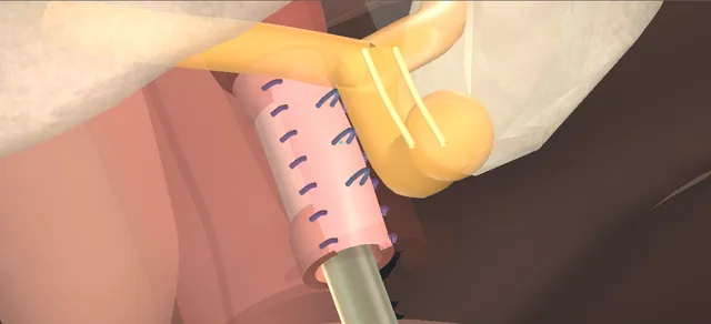 Operative plate: Female urethroplasty