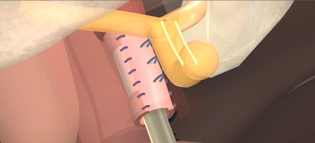 Rendered frame from the Interactive dorsal onlay buccal graft urethroplasty