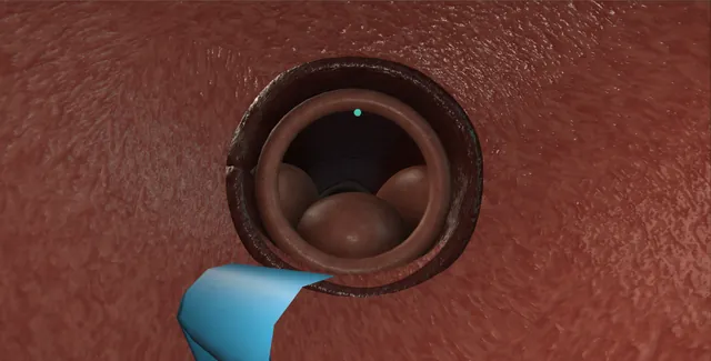 Operative plate: Flexible cystoscopy: the outpatient look