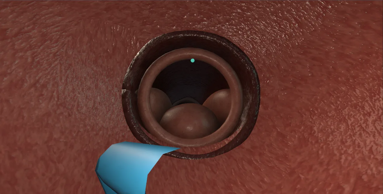 Rendered frame from the Interactive flexible cystoscopy, beat by beat