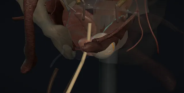 Operative plate: Focal ablation of prostate cancer