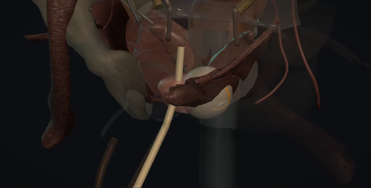 Rendered frame from the Interactive focal ablation planning and delivery
