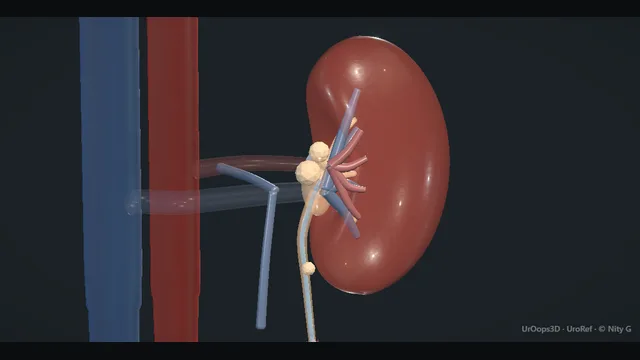 Operative plate: The forgotten stent