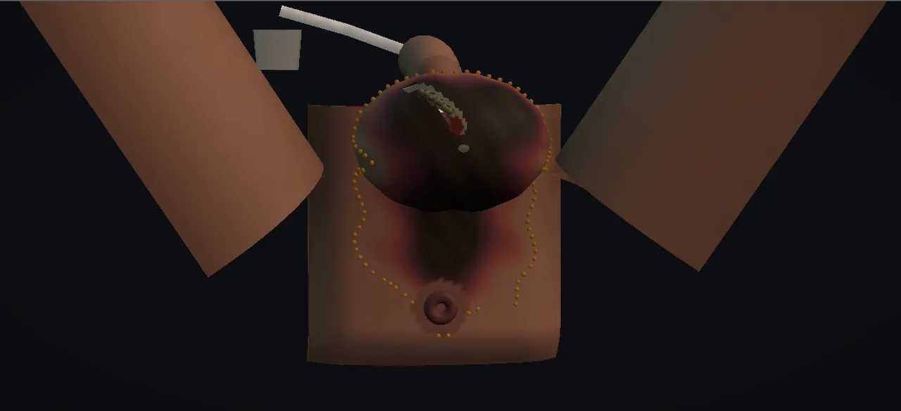 Rendered frame from the Interactive Fournier debridement