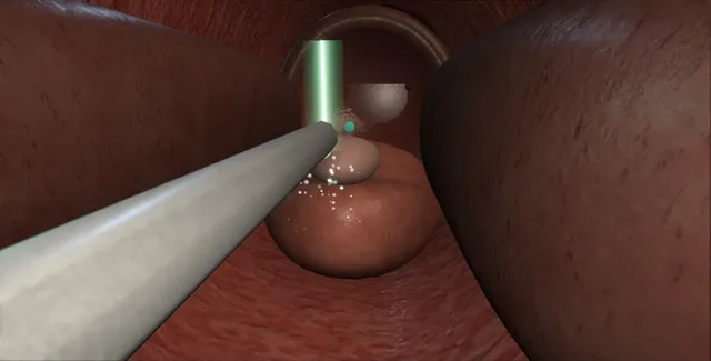 Operative plate: GreenLight laser vaporisation