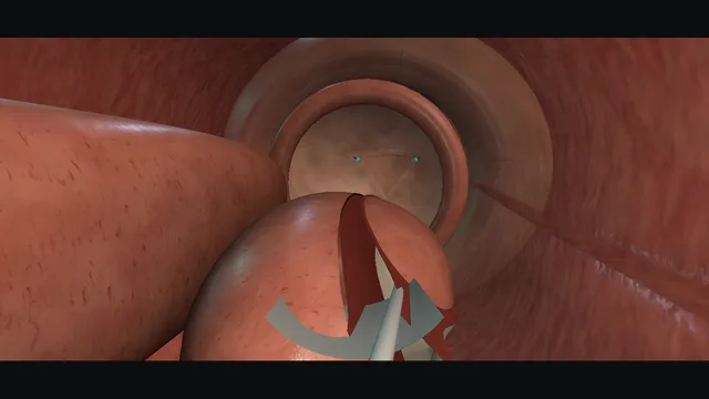 Operative plate: Laser enucleation