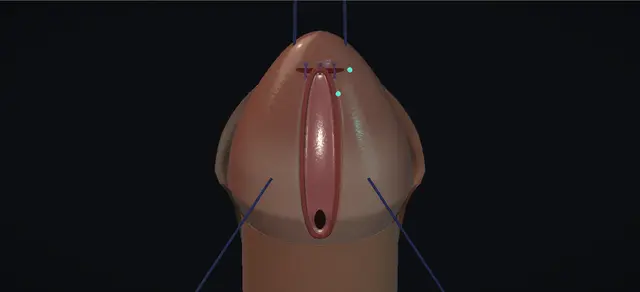 Operative plate: MAGPI hypospadias repair