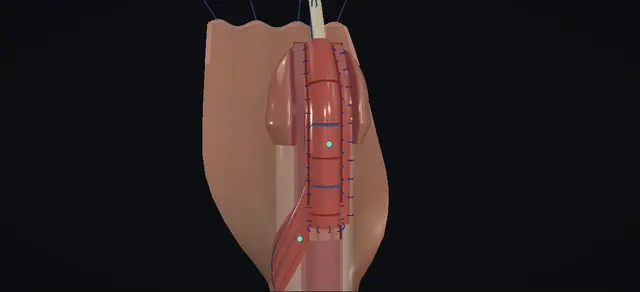 Operative plate: Hypospadias: onlay island flap