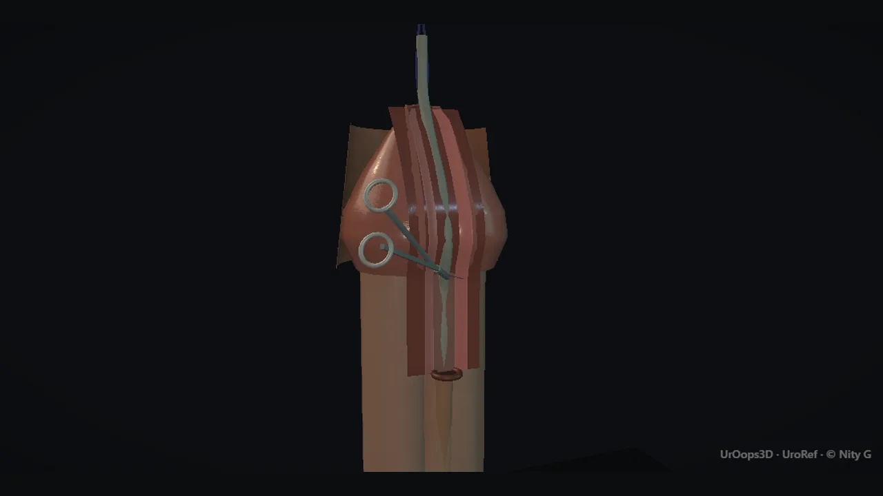 Hypospadias repair: the ventral penis and the urethral plate