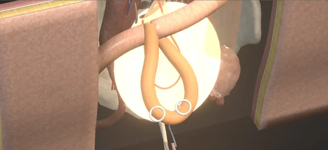 Operative plate: Ileal ureter