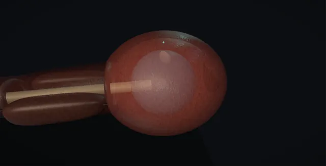 Operative plate: Immediate intravesical chemotherapy