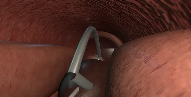 Operative plate: Temporarily implanted nitinol device (iTind)