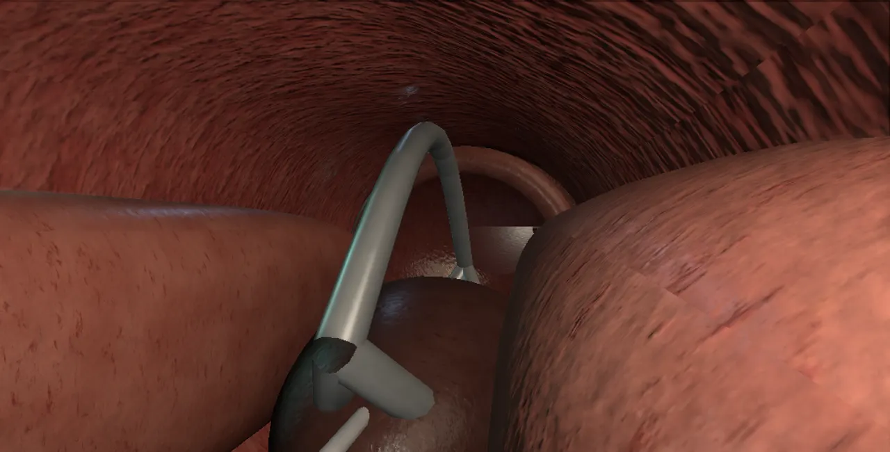 Rendered frame from the Interactive temporary nitinol implant