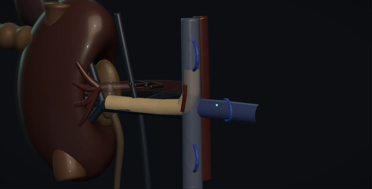 Caval thrombectomy: the vena cava with tumour thrombus and control above and below