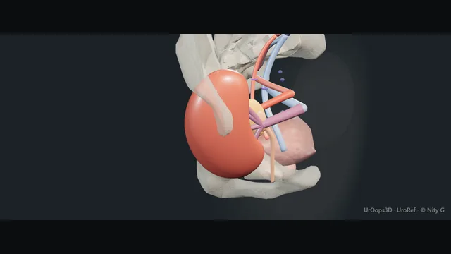 Operative plate: Recipient kidney transplantation