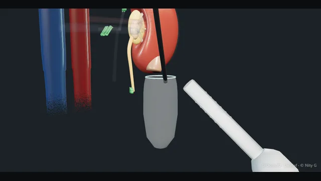 Operative plate: Living-donor nephrectomy
