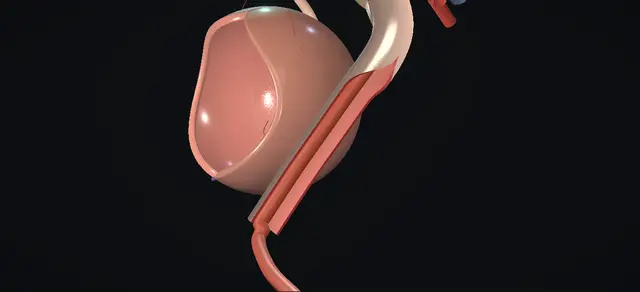 Operative plate: Megaureter repair