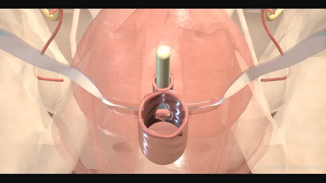 Operative plate: Transobturator sling