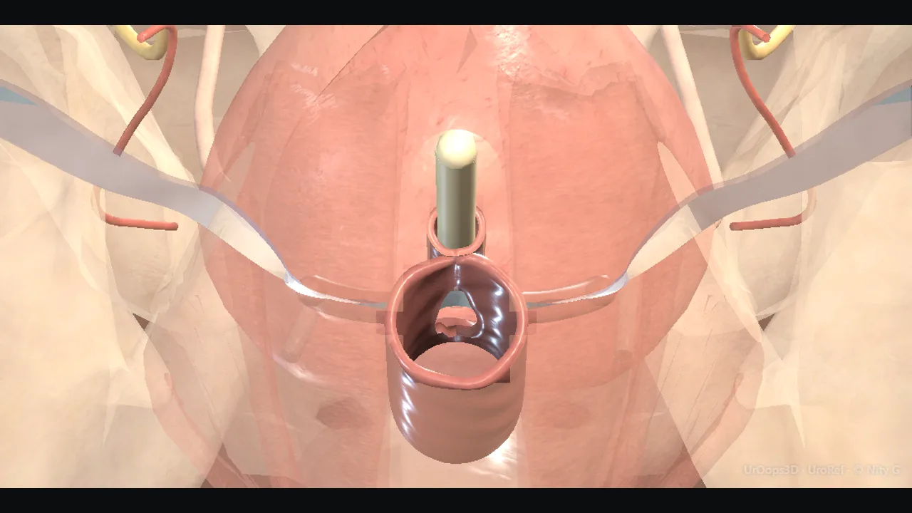 Midurethral sling: the retropubic trocar path beside the bladder