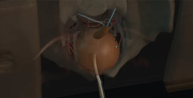 Operative plate: Orthotopic neobladder