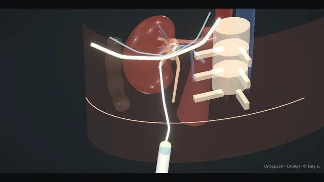 Operative plate: Percutaneous nephrostomy