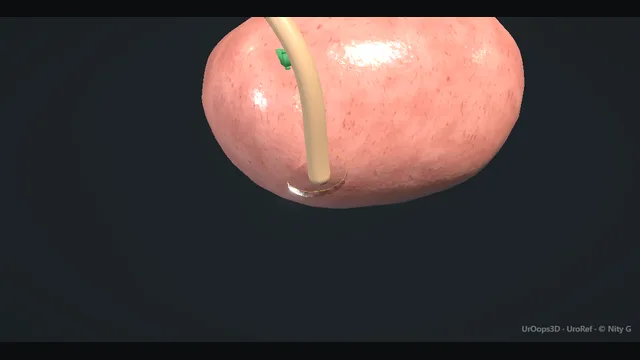 Operative plate: Nephroureterectomy + cuff