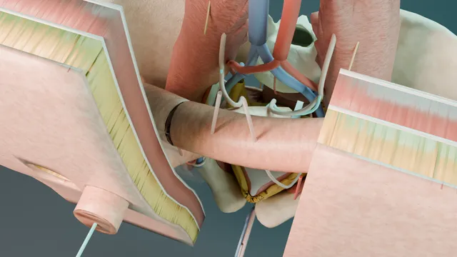 Operative plate: Open supratrigonal cystectomy + ileal conduit