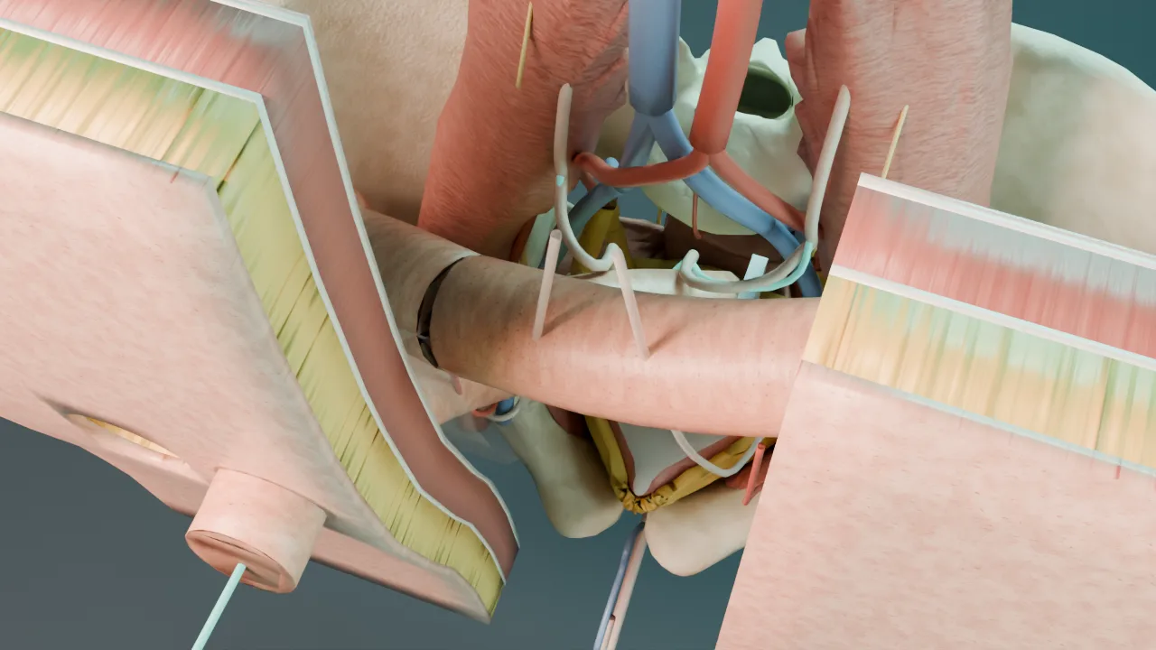 Open cystectomy: the deep pelvis behind the bladder